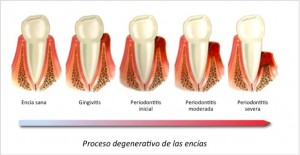 periodoncia1