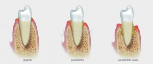 periodoncia2