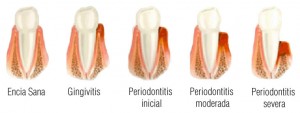 periodoncia3